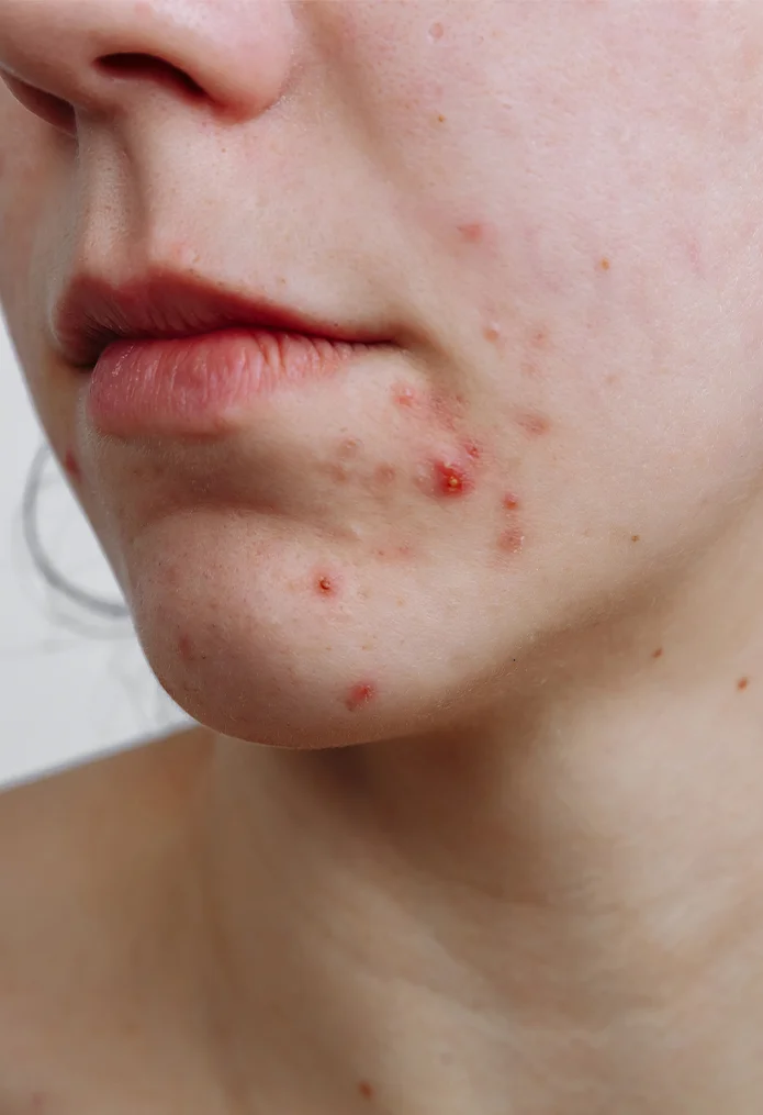 Acne Treatment