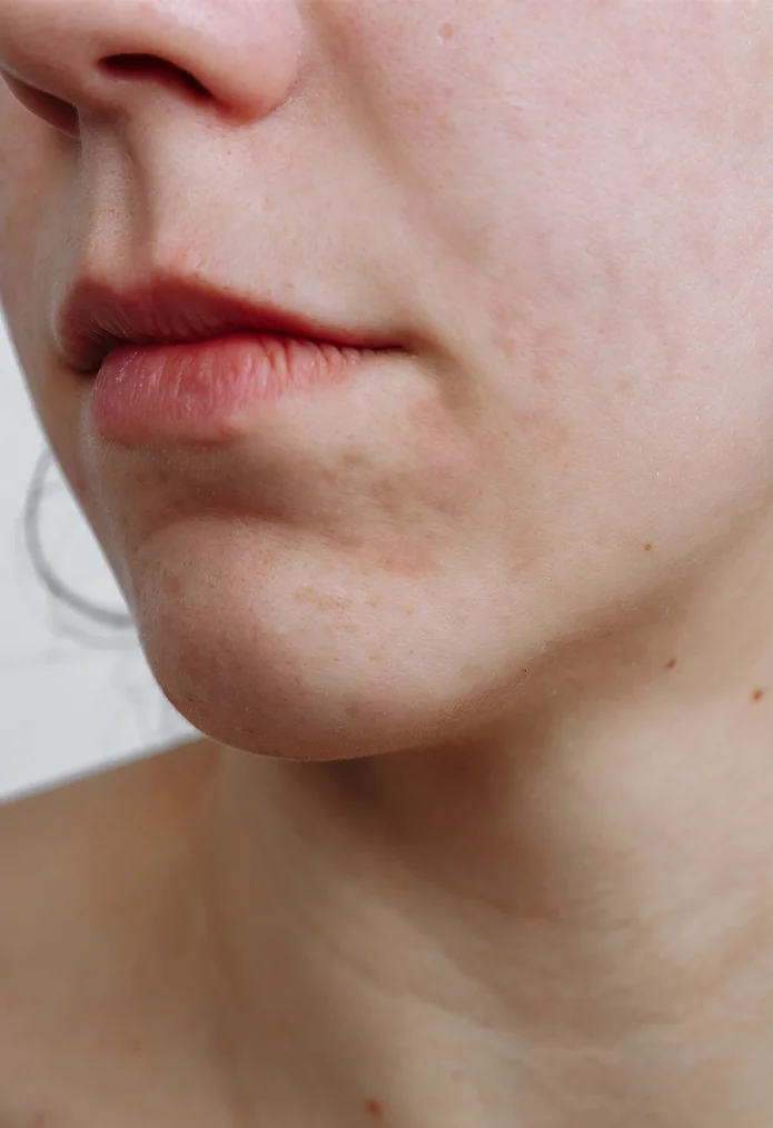 Acne Treatment