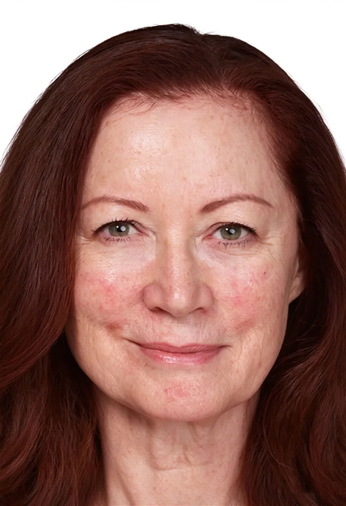 Facial Lifting