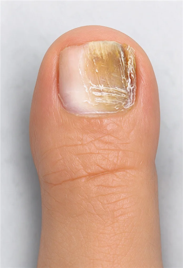 Onychomycosis