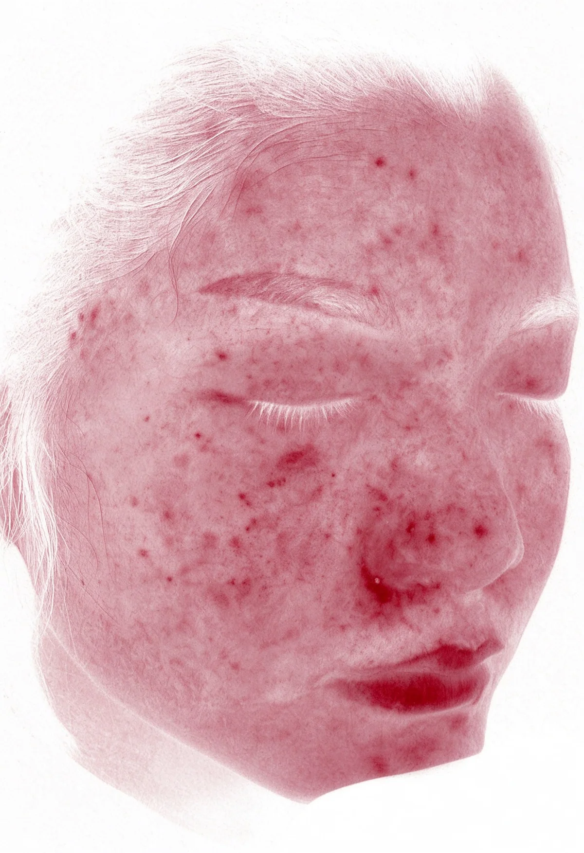 Skin Analysis
