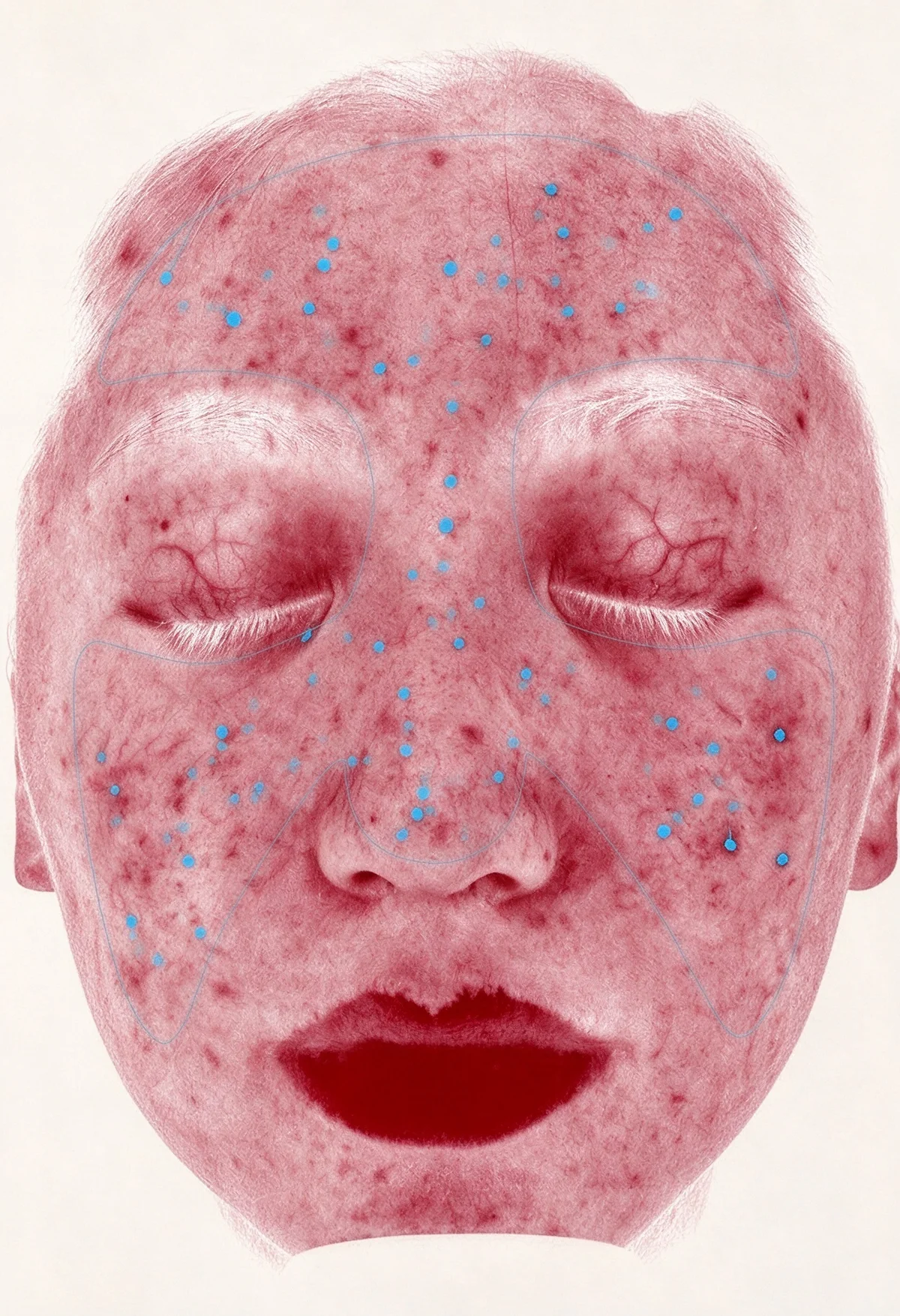 Skin Analysis