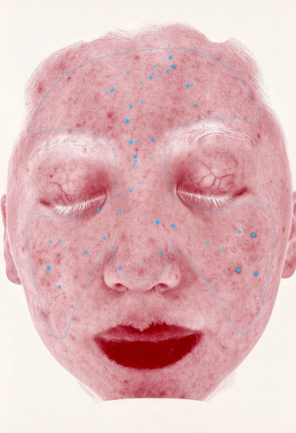 Skin Analysis