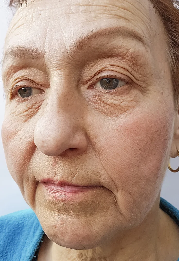 Skin Rejuvenation