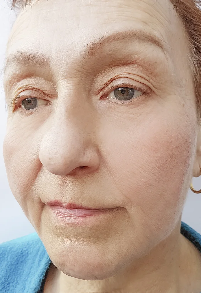Skin Rejuvenation